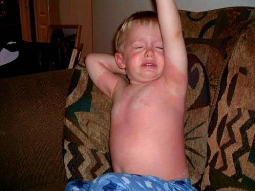 Hives on a little boy Hives on a little boy