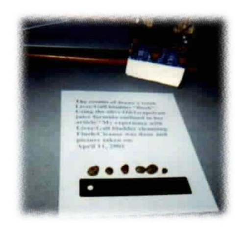 Gall Stones next to a six inch ruler